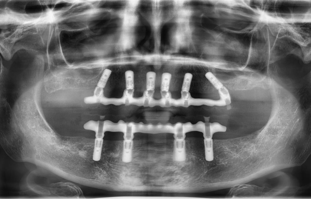 Implantate Röntgenaufnahme Dr. Salfinger